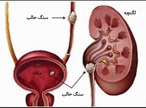 سنگ مجاری ادراری